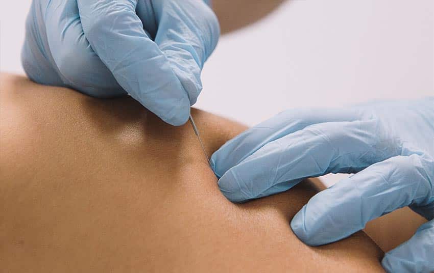 Dry needling in de regio Zwolle